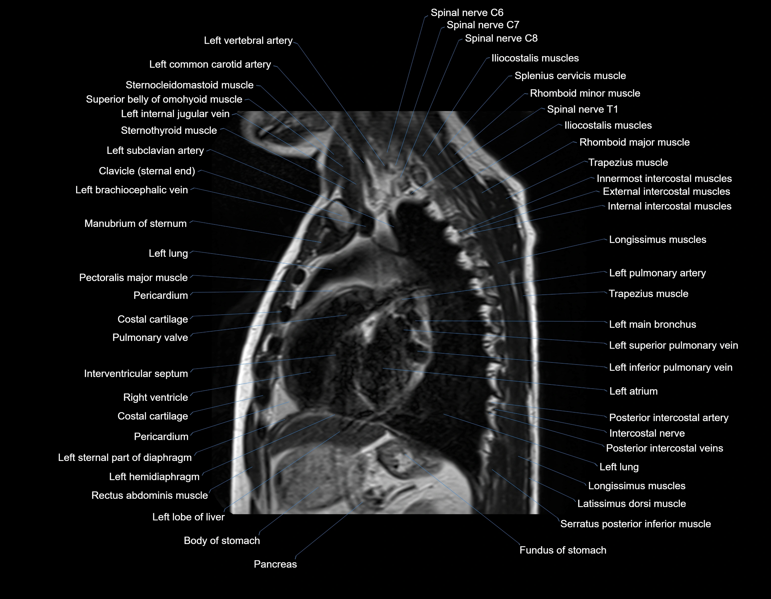 MRI chest (thorax) sagittal labelled cross sectional anatomy 3T radiology image-img-00001-00023.webp